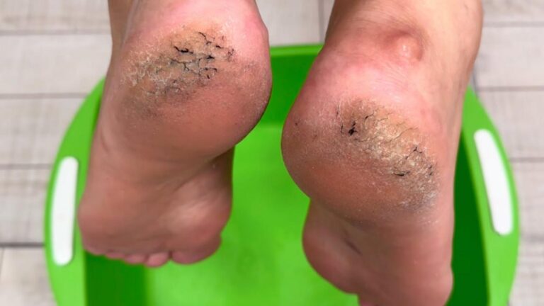 Cette méthode simple va réparer vos talons fissurés en un rien de temps…