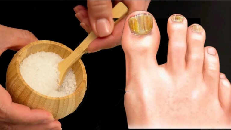 Cette astuce naturelle vous débarrassera des mycoses d’ongles en un rien de temps…