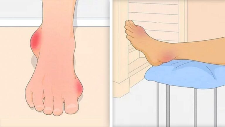 Cette méthode simple soulage la goutte en quelques jours…