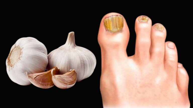 Cette vieille astuce à base d’ail élimine le champignon des ongles en un rien de temps…