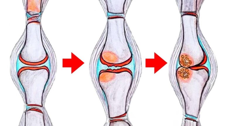 Cette méthode alimentaire transforme vos douleurs d’arthrose en soulagement…