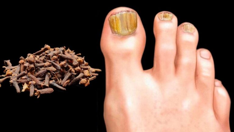 Cette astuce étonnante élimine le champignon des ongles en un rien de temps…